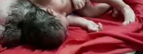 Baby Born With Three Heads