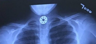 Fidget Spinner X-Ray