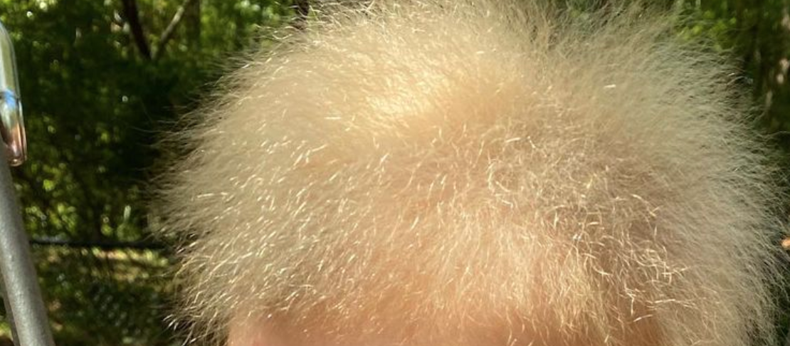 Uncombable Hair Syndrome?!