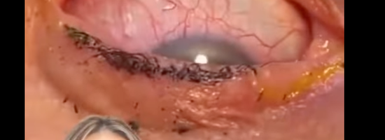 23 Contacts Stuck in Eye!