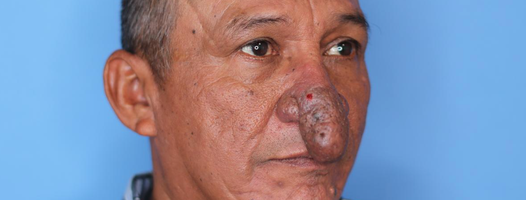 Man's Impressive Nose Surgery