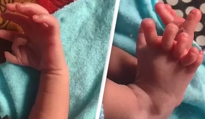 Baby With 26 Fingers