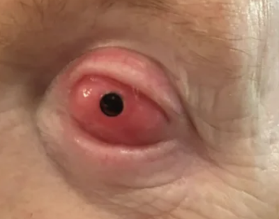 Tooth In Eye Surgery