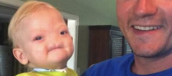 Nose-less Baby