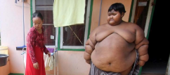 Morbidly Obese 10-year-old