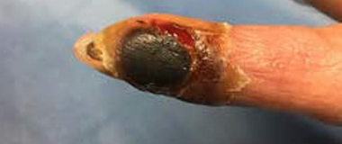 Smallpox Finger