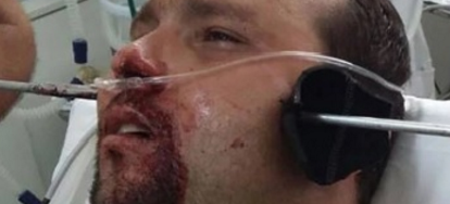 Fisherman Takes Harpoon To The Face!